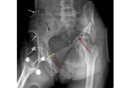 Verbrijzelingsfractuur bekken