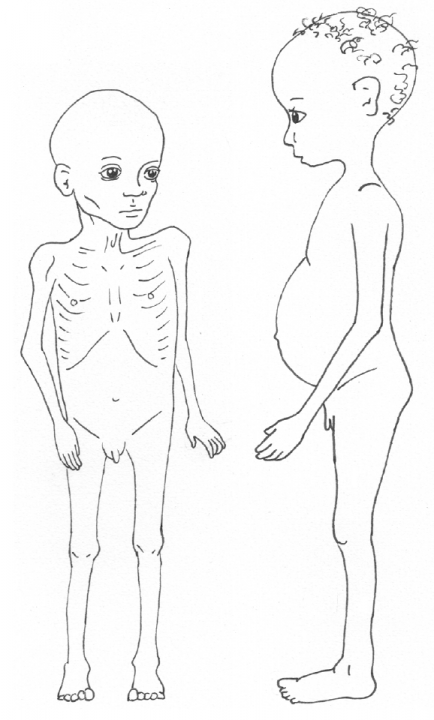 Figuur 17.3 Typerend uiterlijk van kinderen met marasmus (links) en kwashiorkor (rechts).