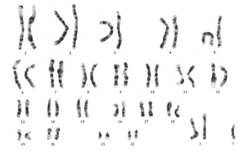 Figure 3.2 Human karyotype. Humans have 22 pairs of autosomes and one pair of sex chromosomes, X and Y. This karyotype is of an individual with Klinefelter syndrome, as they have an XXY genotype. Typically a male would be XY and a female XX.