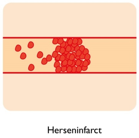 Een herseninfarct is een permanente verstopping van de bloedcirculatie