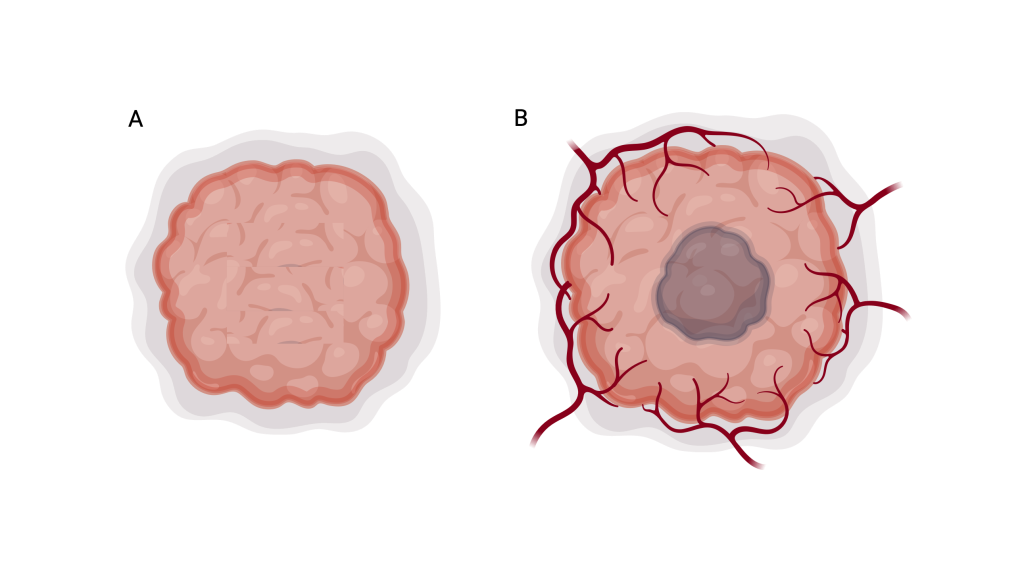 Figure 9.1 Benign and malignant tumour. A benign tumour (A) is demarcated from surrounding tissue, while a malignant tumour (B) begins to invade and damage healthy cells.