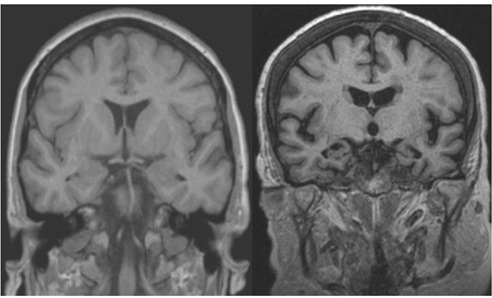 Figuur 21.3 MRI beeld van een een patiënt met subjectieve klachten waarbij geen sprake is van atrofie (links) en een Alzheimerpatiënt met hippocampus-atrofie (rechts). Beide MRI’s: T1-gewogen, coronale opname.