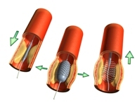 bloedvat dotteren en plaatsen van stent