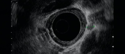 Er werd een pathologische para-oesofageale klier gevonden van een centimeter groot. De tumor is nu geclassificeerd als T3N1