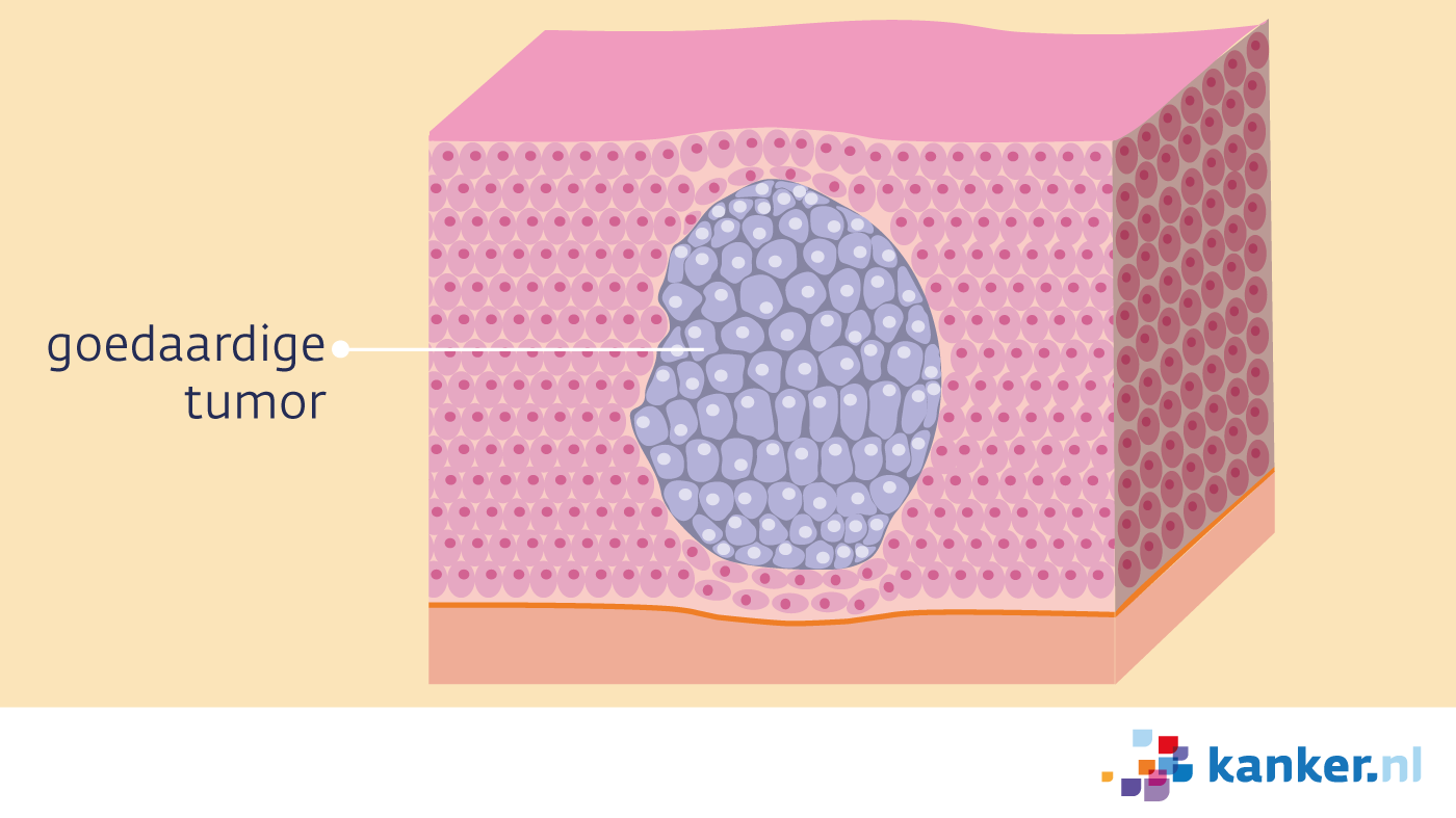 Goedaardige tumor kanker.nl